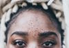 6 Natural Remedies for Dark Spots