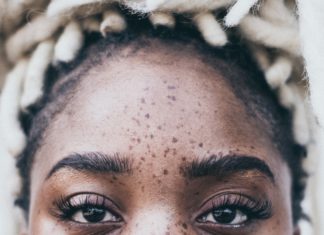 6 Natural Remedies for Dark Spots