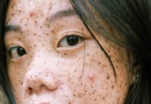 Get Rid of Acne Permanently Pimples