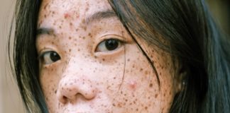 Get Rid of Acne Permanently Pimples