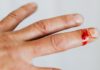 How to Treat Stings and Bites At Home could be a snake bite