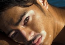 Skin Disorders and Treatment Skin disorder