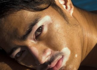 Skin Disorders and Treatment Skin disorder