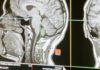 What Do You Know About Brain Tumor? brain