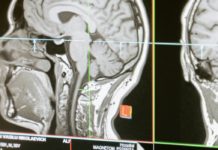 What Do You Know About Brain Tumor? brain