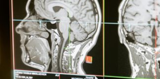 17 Habits that Damage the Brain brain