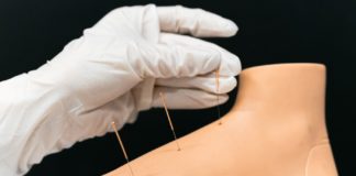 What Can Moxibustion Therapy Offer Your Health? acupuncture