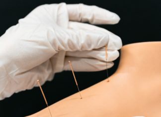 What Can Moxibustion Therapy Offer Your Health? acupuncture