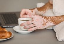 Skin Conditions with Ulcerative Colitis vitiligo