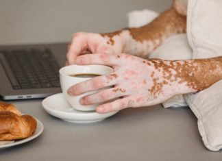 Skin Conditions with Ulcerative Colitis vitiligo
