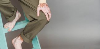 Vitiligo: Symptoms, Causes, & Treatment vitiligo