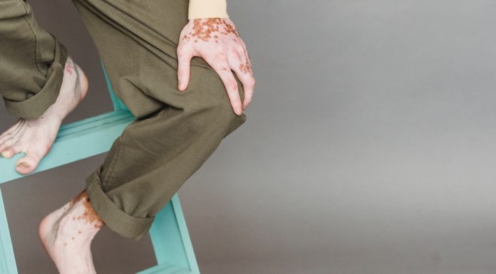 Vitiligo: Symptoms, Causes, & Treatment vitiligo