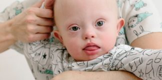 Down Syndrome: Causes, Symptoms, Prevention, And Treatment down syndrome child