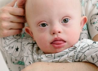 Down Syndrome: Causes, Symptoms, Prevention, And Treatment down syndrome child