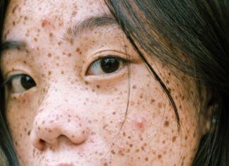 What Are Moles, Freckles & Skin Tags? freckles