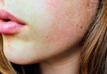 What you Should Know About Rubella skin