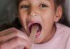 Tonsillitis: Causes, Symptoms & Treatment throat