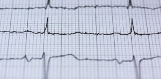 Tachycardia: Causes, Symptoms, Treatment Tachycardia: Causes, Symptoms, Treatment