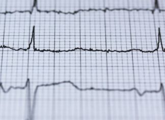 Tachycardia: Causes, Symptoms, Treatment Tachycardia: Causes, Symptoms, Treatment